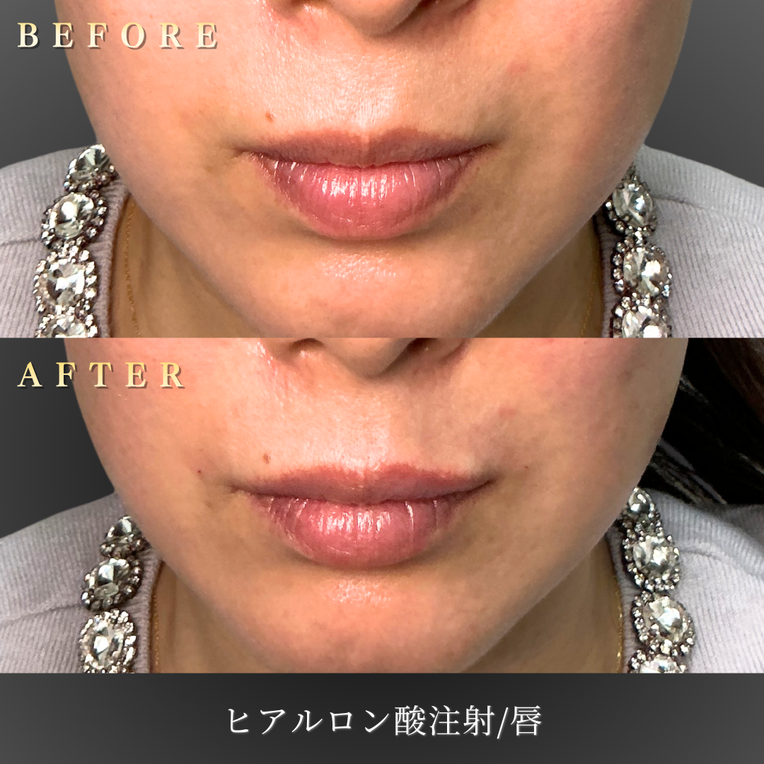 唇のハリ回復後の自然な表情写真