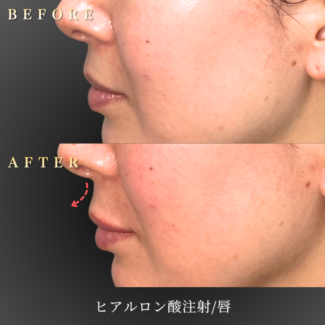 【40代女性】ハリを取り戻す唇ヒアルロン酸症例｜大阪 心斎橋BiBiクリニックの症例写真