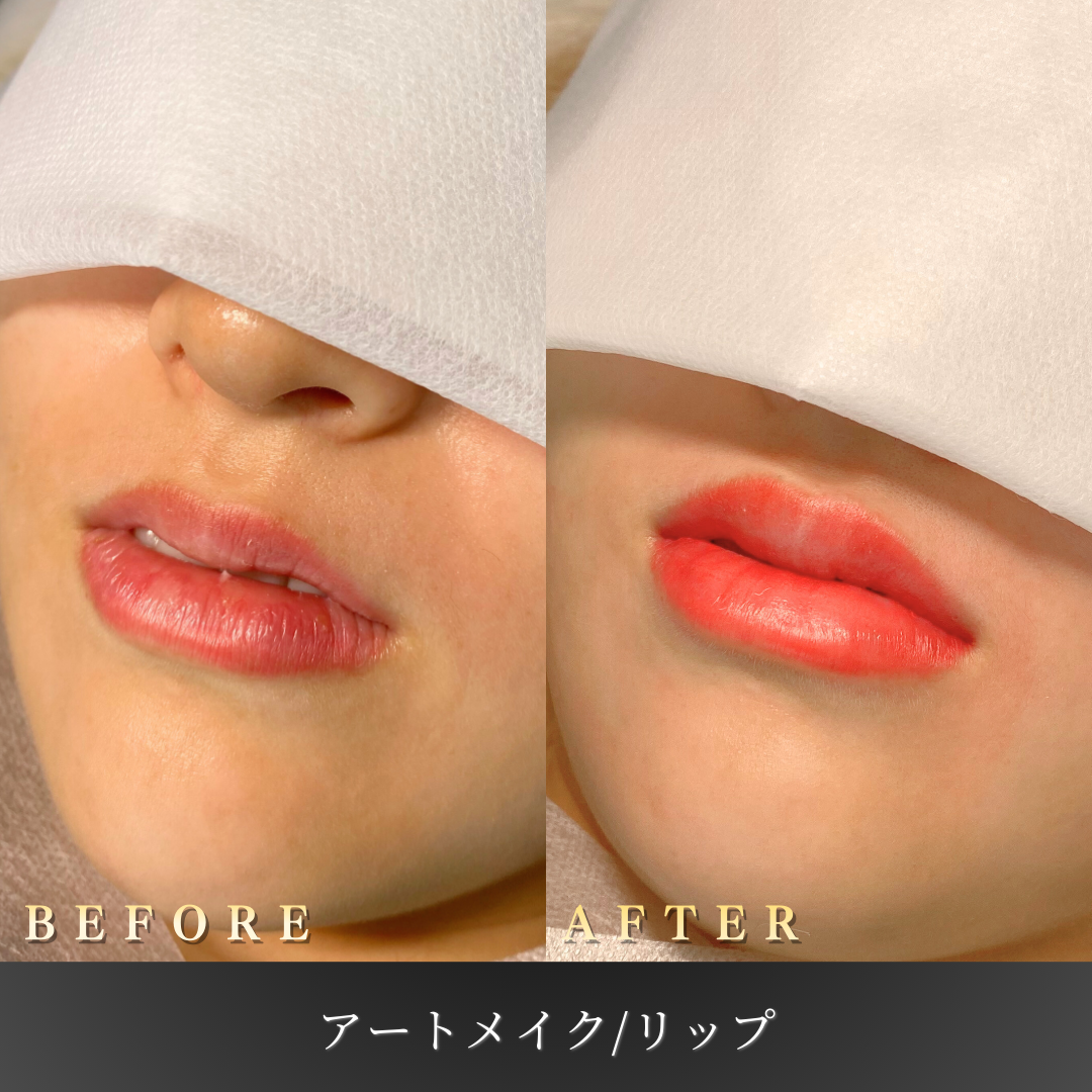 【20代女性】ナチュラルな発色を叶えるリップアートメイク症例｜大阪 心斎橋BiBiクリニックの症例写真
