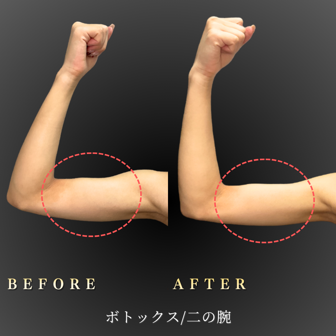 【20代女性】腕ラインを整える二の腕ボトックス症例｜大阪 心斎橋BiBiクリニックの症例写真