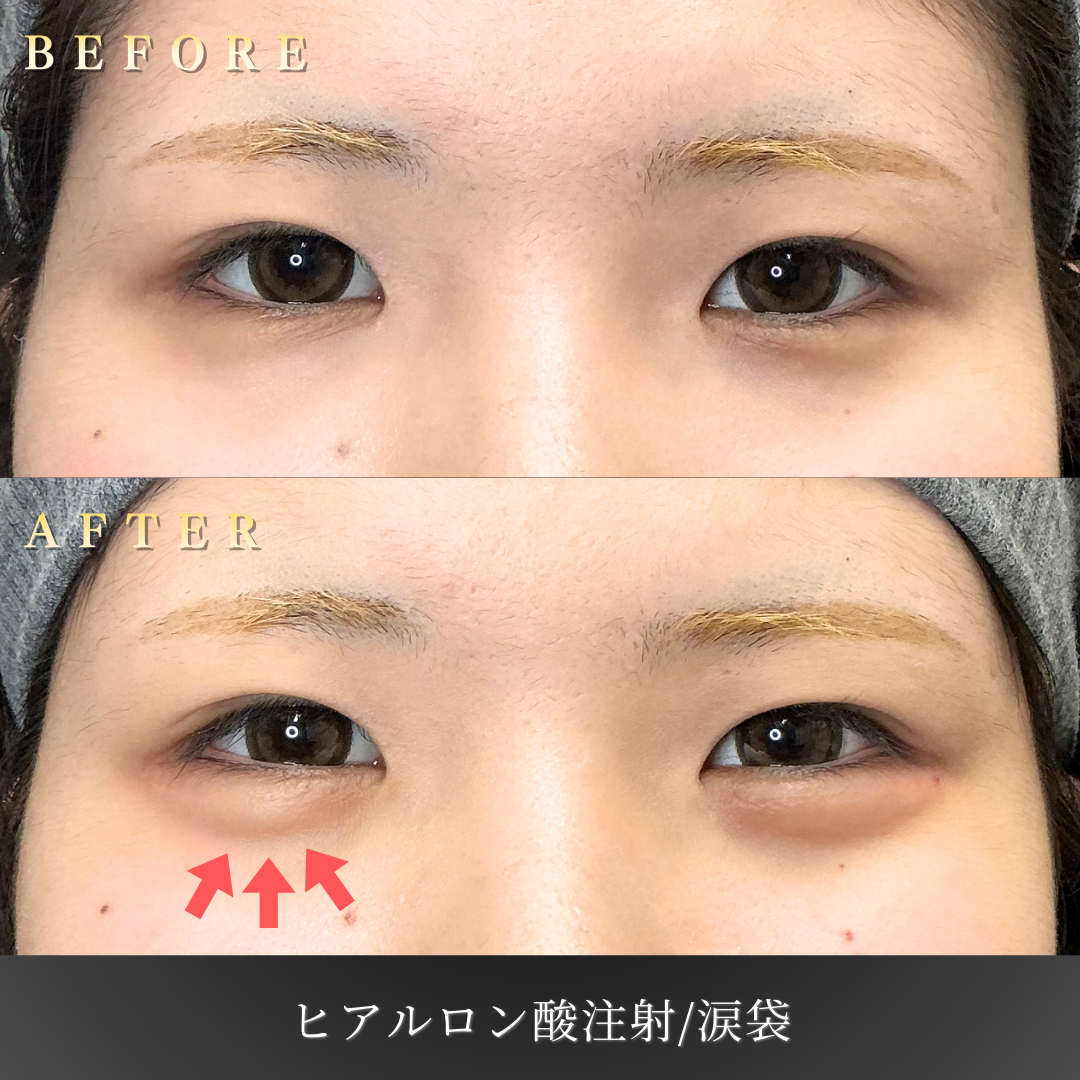 【10代女性】写真映えを意識した涙袋ヒアルロン酸症例｜大阪 心斎橋BiBiクリニックの症例写真