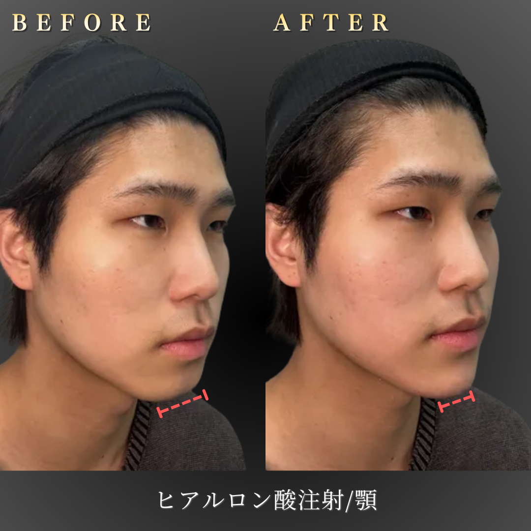 【20代男性】横顔に立体感を出す顎ヒアルロン酸症例｜大阪 心斎橋BiBiクリニックの症例写真