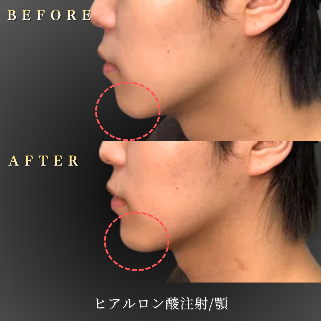 20代男性の顎ヒアルロン酸施術（左横Before/After）
