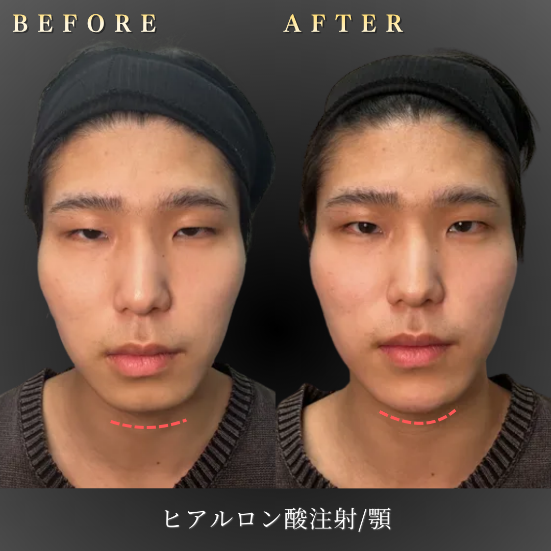 20代男性の顎ヒアルロン酸施術（正面Before/After）