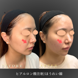 20代 ほうれい線ヒアルロン酸 症例写真〔右斜め45度 Before_After〕｜大阪 心斎橋BiBiクリニック