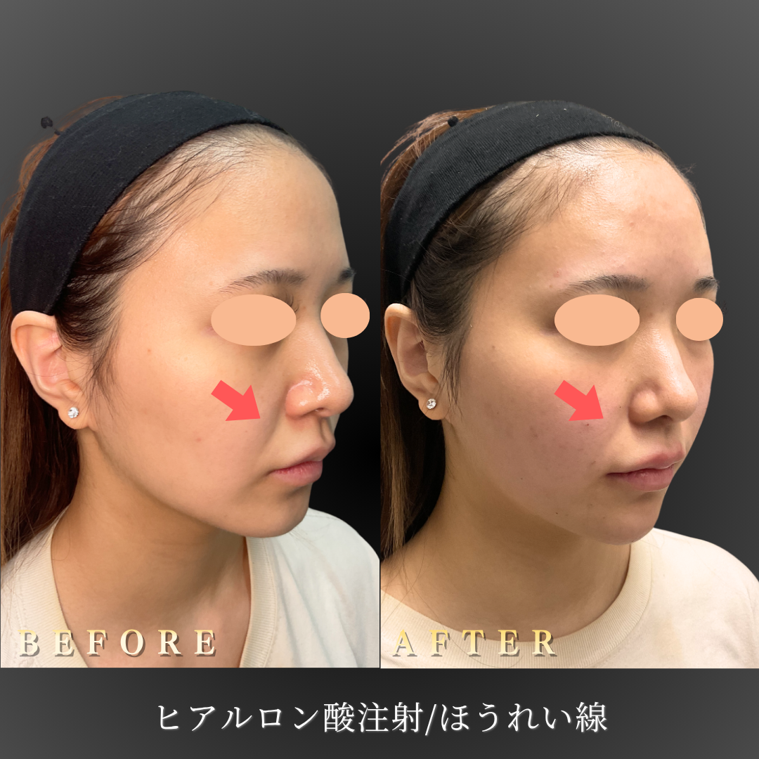 【20代女性】メイクが溝に落ちるほうれい線を整える症例｜大阪 心斎橋BiBiクリニックの症例写真