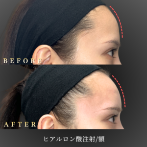 20代 ほうれい線ヒアルロン酸 症例写真〔右横Before_After〕｜大阪 心斎橋BiBiクリニック