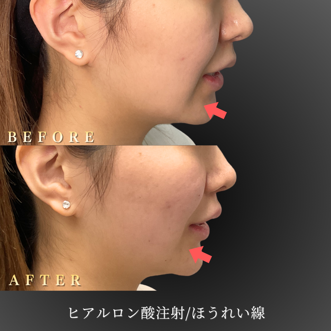 20代女性のほうれい線ヒアルロン酸注入施術後の右横写真