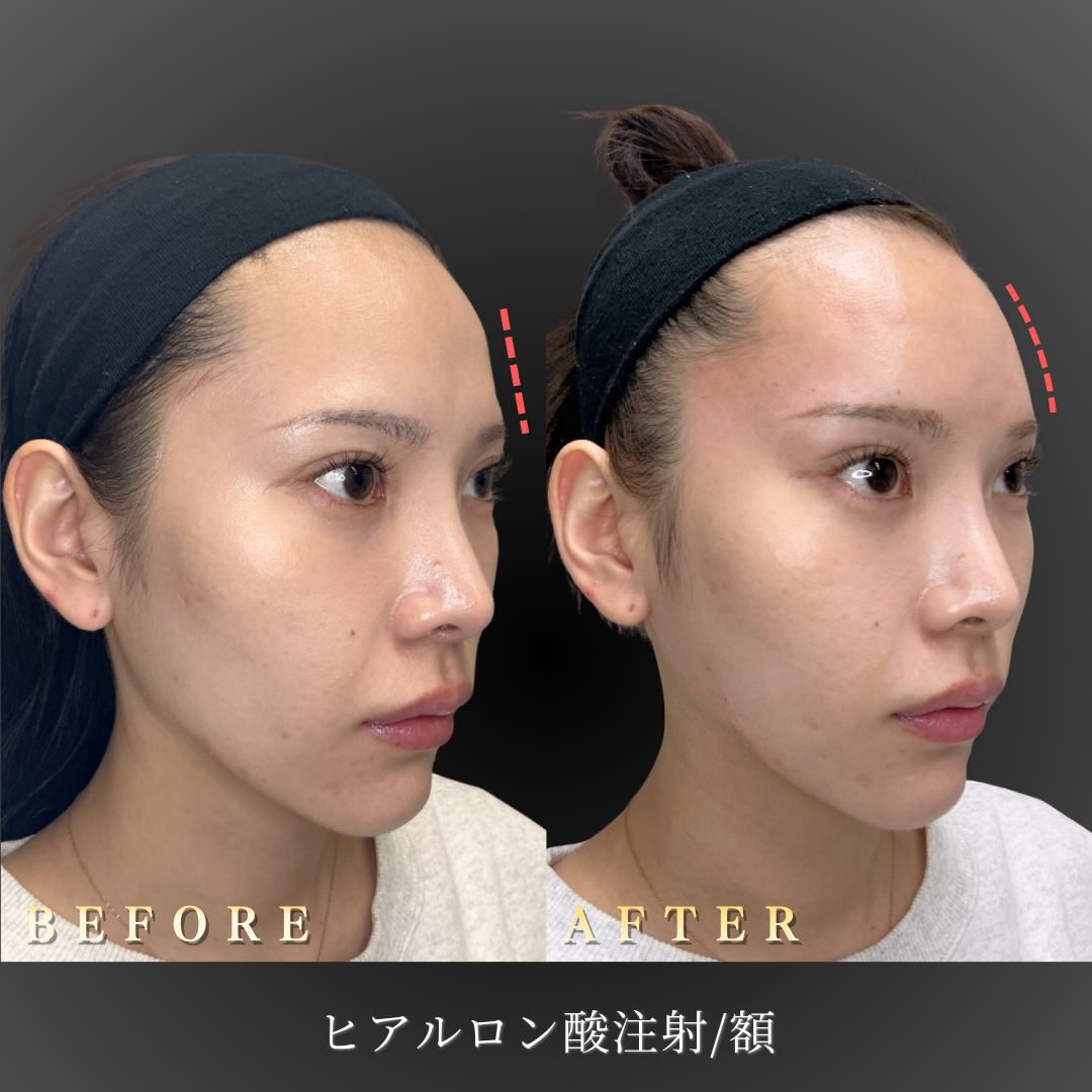 20代女性の額ヒアルロン酸施術のBefore/After（左45度）