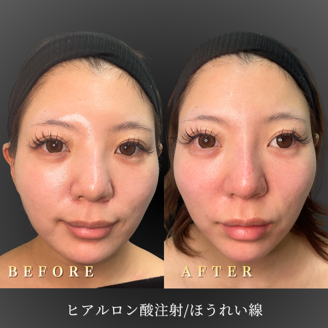 20代女性のほうれい線ヒアルロン酸施術前後の正面写真