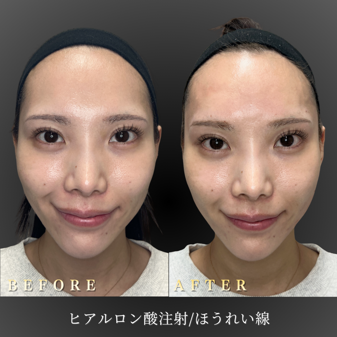 20代女性の額ヒアルロン酸施術の正面Before/After写真