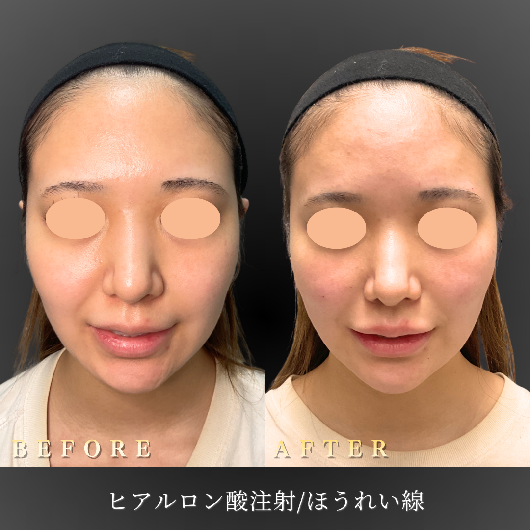 20代女性のほうれい線ヒアルロン酸注入施術後の正面写真