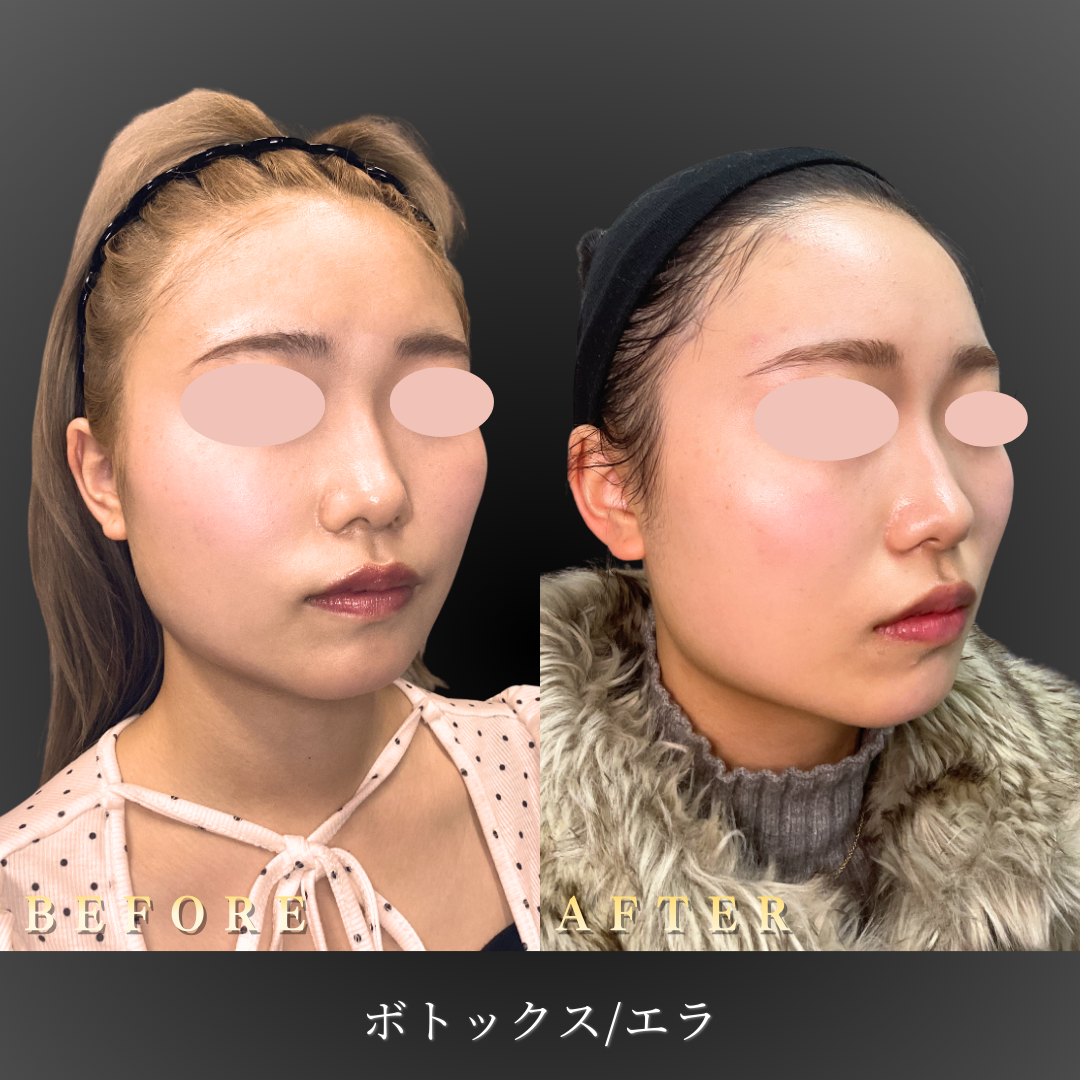 20代女性 エラボトックス45度角Before/After
