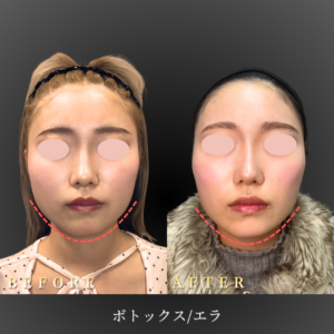 20代 エラボトックス 症例写真〔正面Before_After〕｜大阪 心斎橋BiBiクリニック