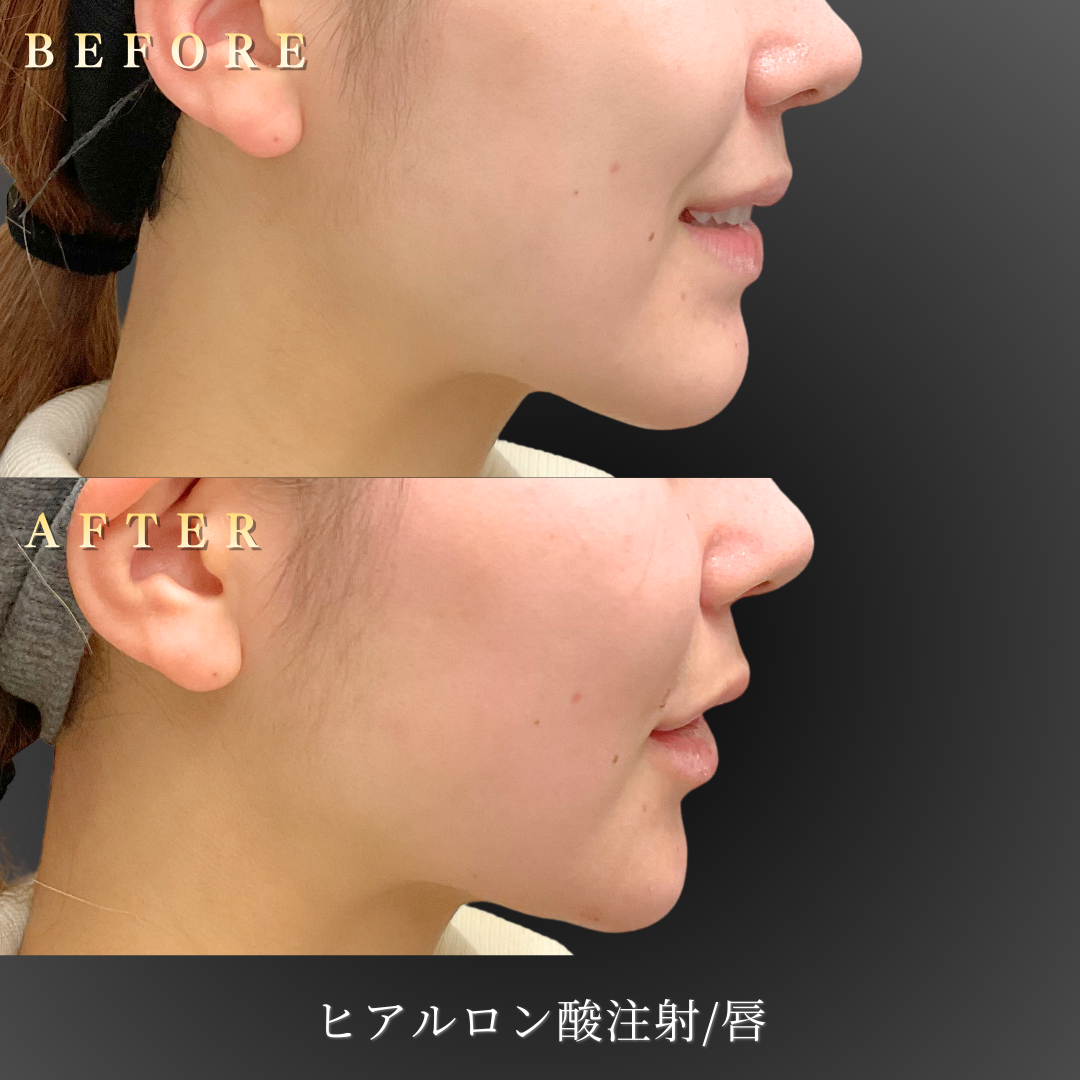 20代女性の唇ヒアルロン酸施術後の右横写真