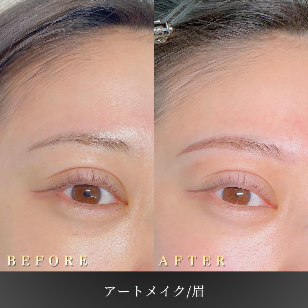 20代女性の眉アートメイク症例 正面Before/After