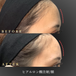 20代 額ヒアルロン酸 症例写真〔右横Before_After〕｜大阪 心斎橋BiBiクリニック