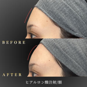 20代 額ヒアルロン酸 症例写真〔左横Before_After〕｜大阪 心斎橋BiBiクリニック (2)