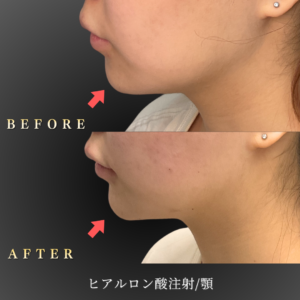 20代 顎ヒアルロン酸 症例写真〔右横Before_After〕｜大阪 心斎橋BiBiクリニック