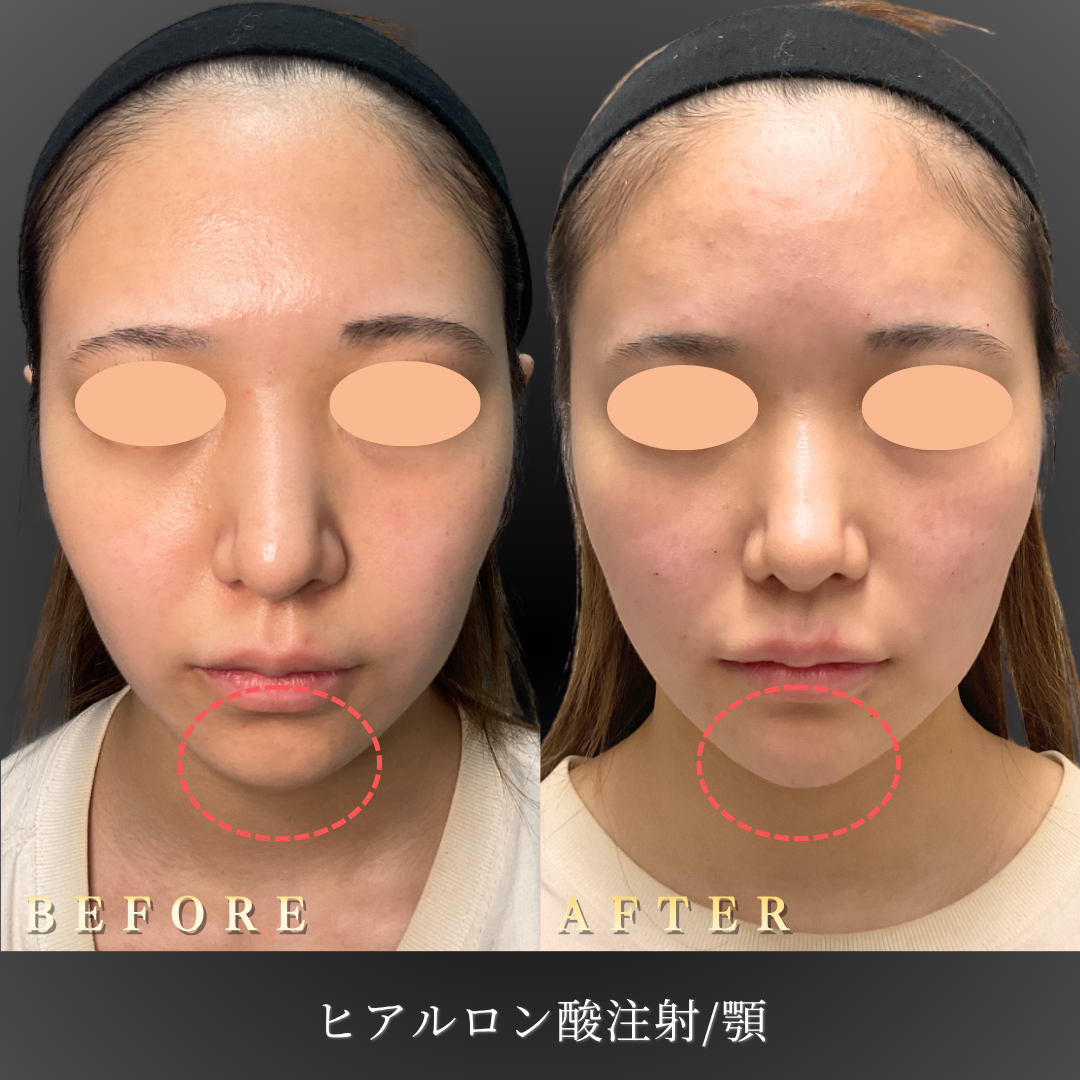 20代女性の顎ヒアルロン酸施術前後の正面写真