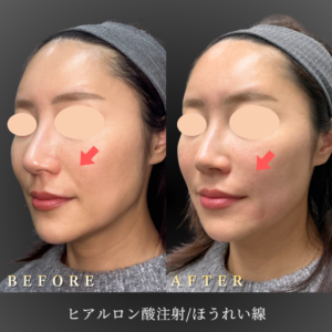 30代 ほうれい線ヒアルロン酸 症例写真〔左45度Before_After〕｜大阪 心斎橋BiBiクリニック