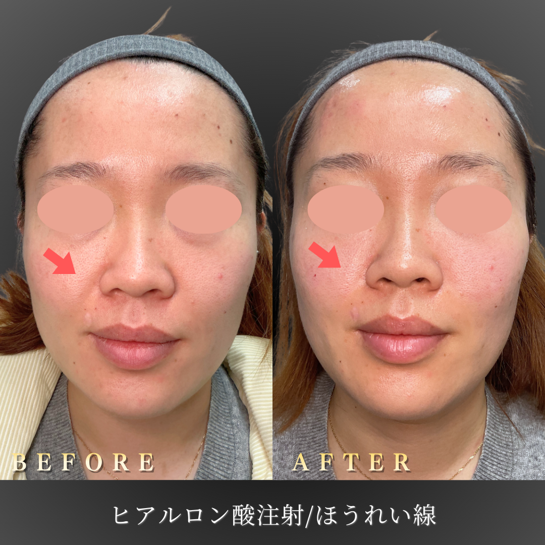 【30代女性】将来深くなる前に整えるほうれい線症例｜大阪 心斎橋BiBiクリニックの症例写真