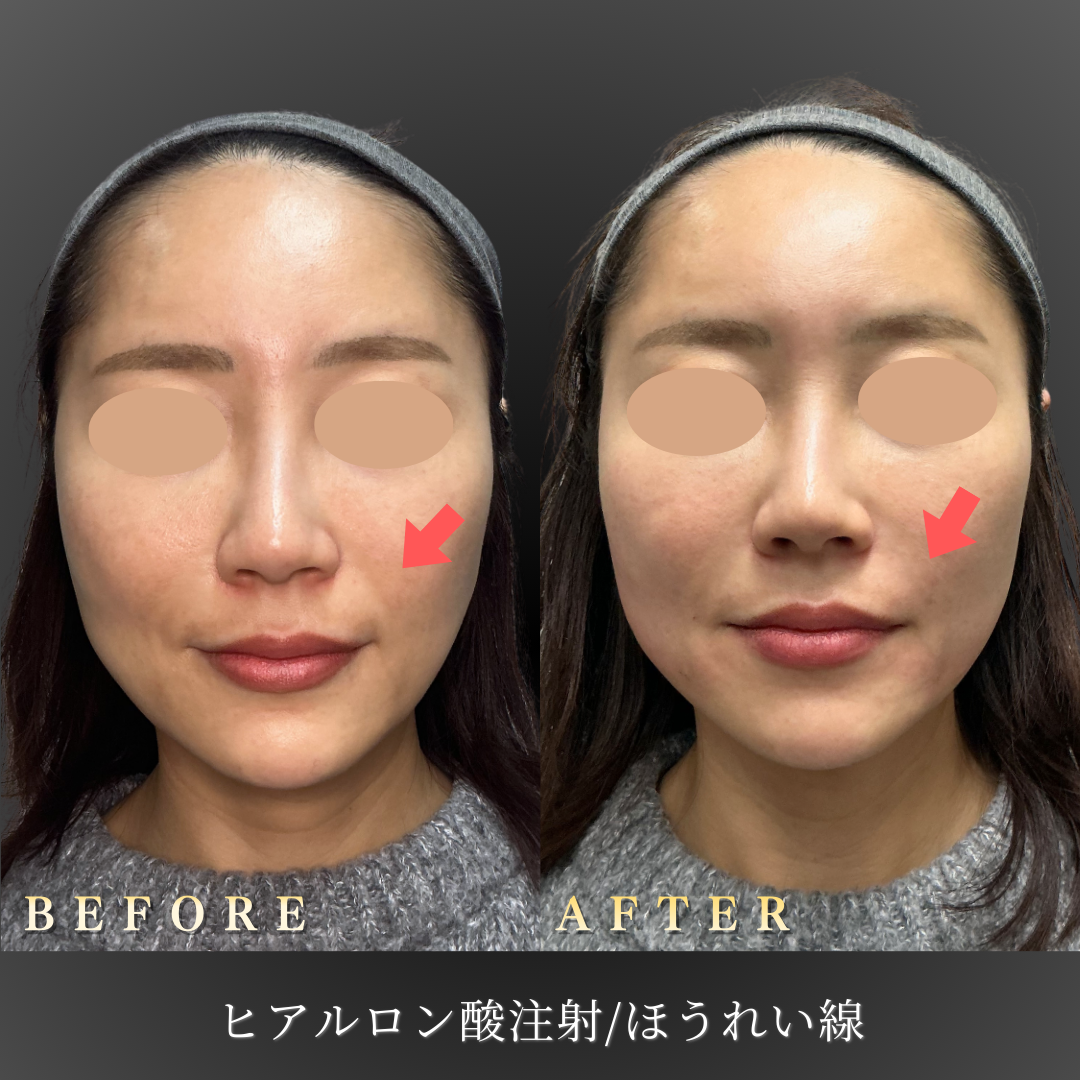 30代女性のほうれい線ヒアルロン酸施術前後の正面からの比較写真