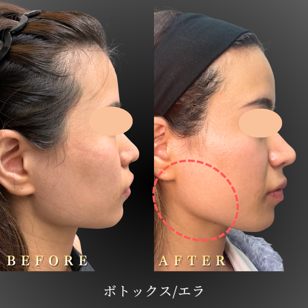 【30代女性】強くなったエラ張りを整えるエラボトックス症例｜大阪 心斎橋BiBiクリニックの症例写真