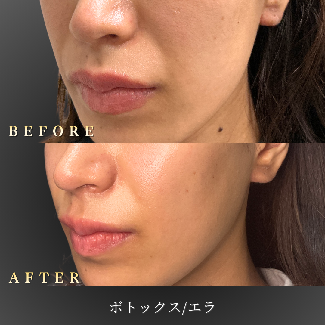30代女性のエラボトックス施術前後写真（左45度角）