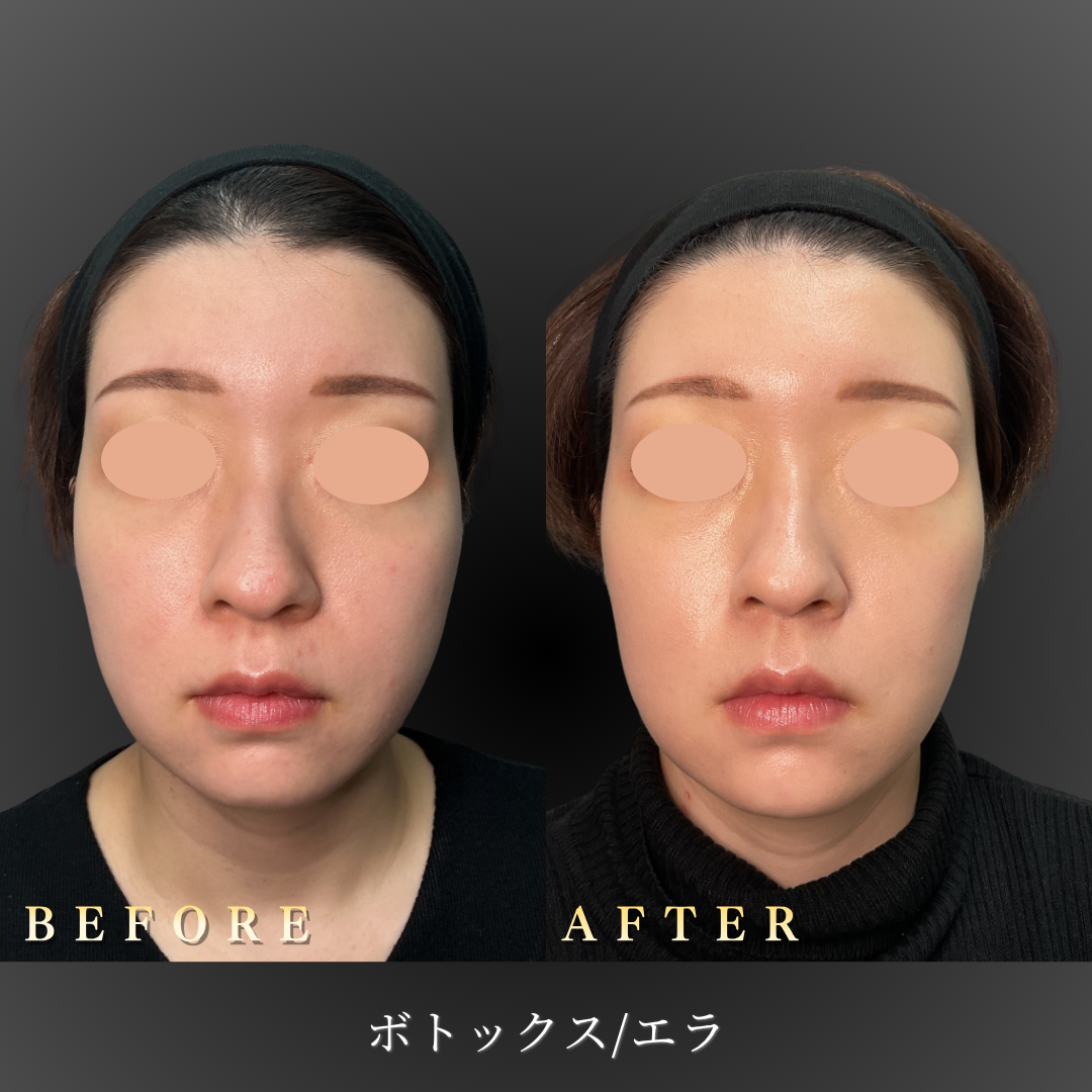 30代女性のエラボトックス施術後の正面写真