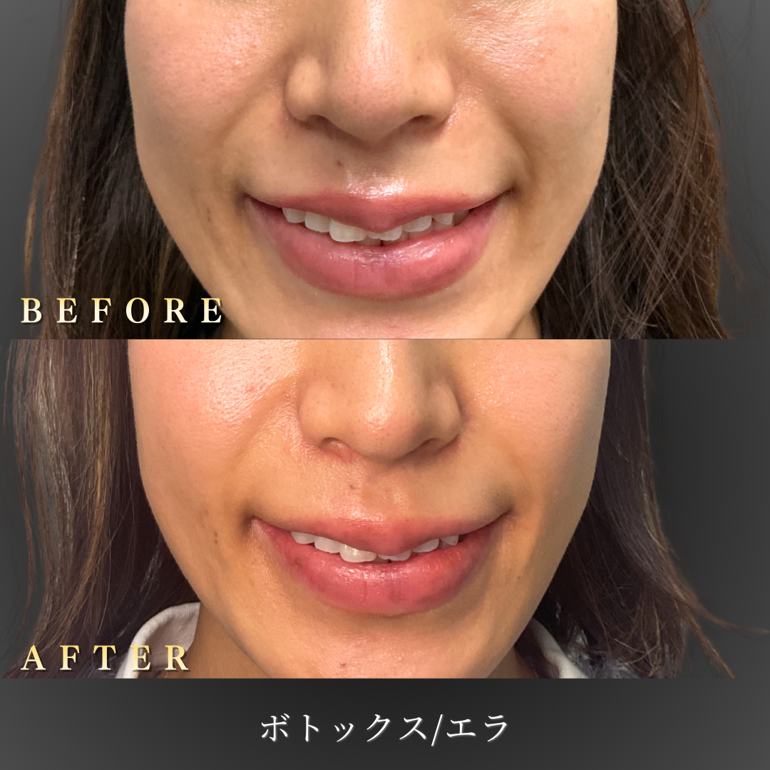 30代女性のエラボトックス施術前後写真（正面）