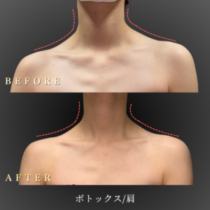 30代 ボトックス 症例写真〔正面Before_After〕｜大阪 心斎橋BiBiクリニック