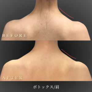 30代 ボトックス 症例写真〔背面BeforeAfter〕｜大阪 心斎橋BiBiクリニック