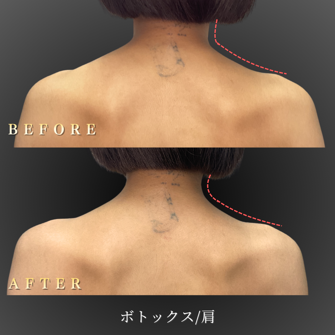 30代女性の肩ボトックス症例写真 背面角度