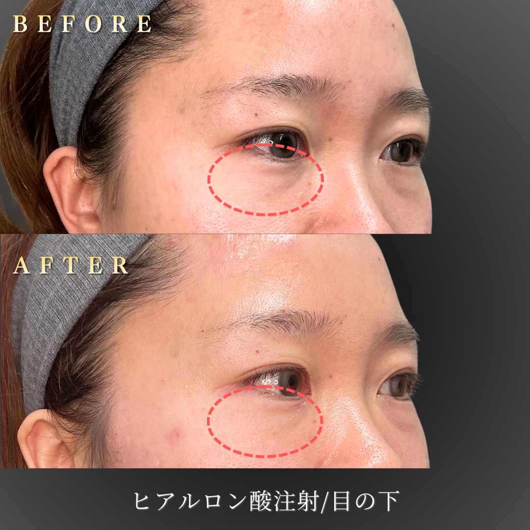 30代女性の目の下ヒアルロン酸施術前後の右45度写真