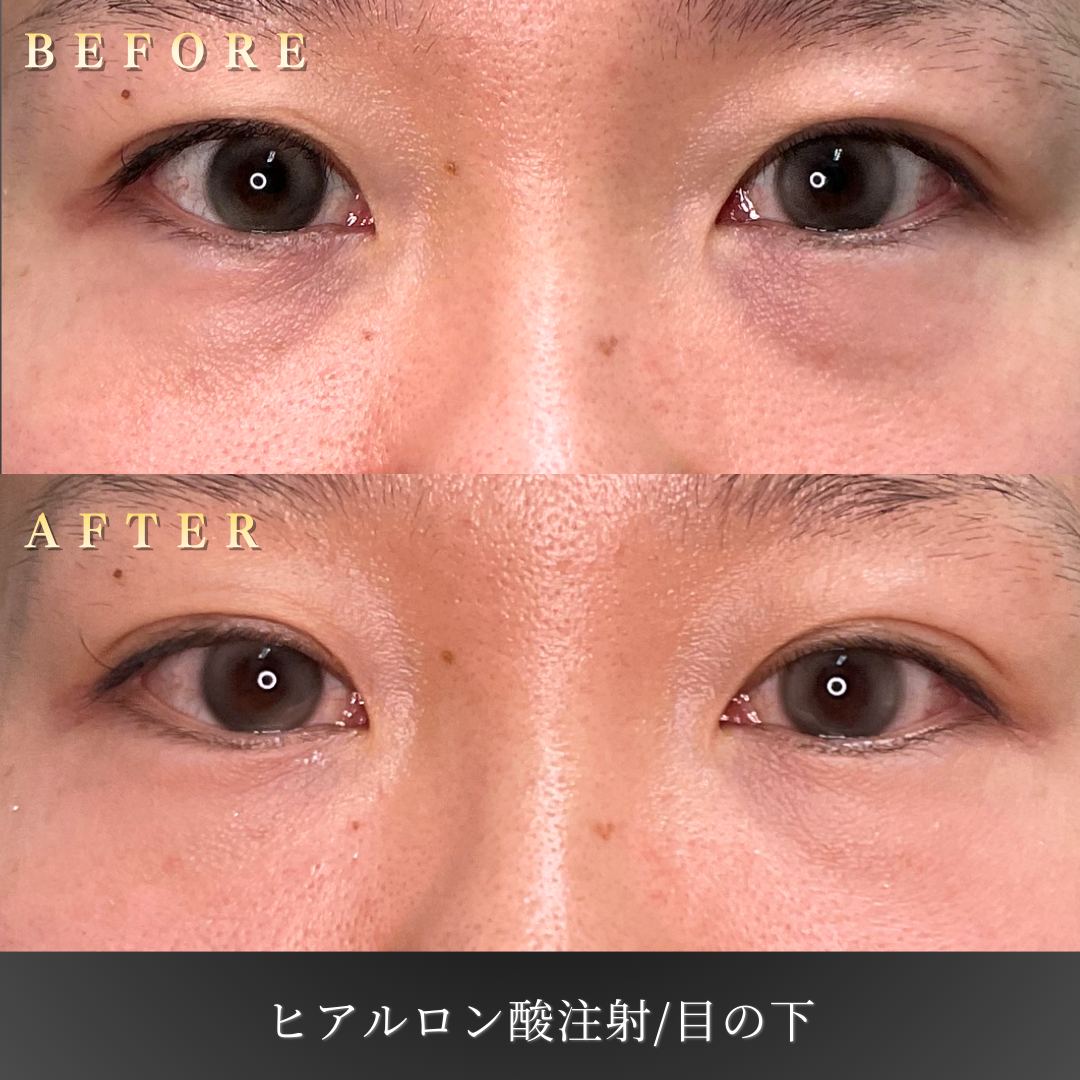 【30代女性】疲労感を改善する中顔面ヒアルロン酸症例｜大阪 心斎橋BiBiクリニックの症例写真