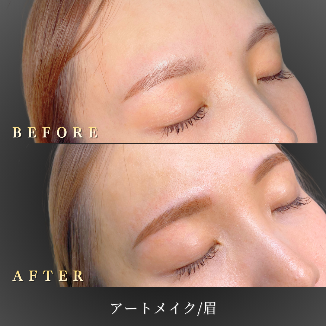 30代女性の眉アートメイク：斜め45度からのBefore/After比較写真