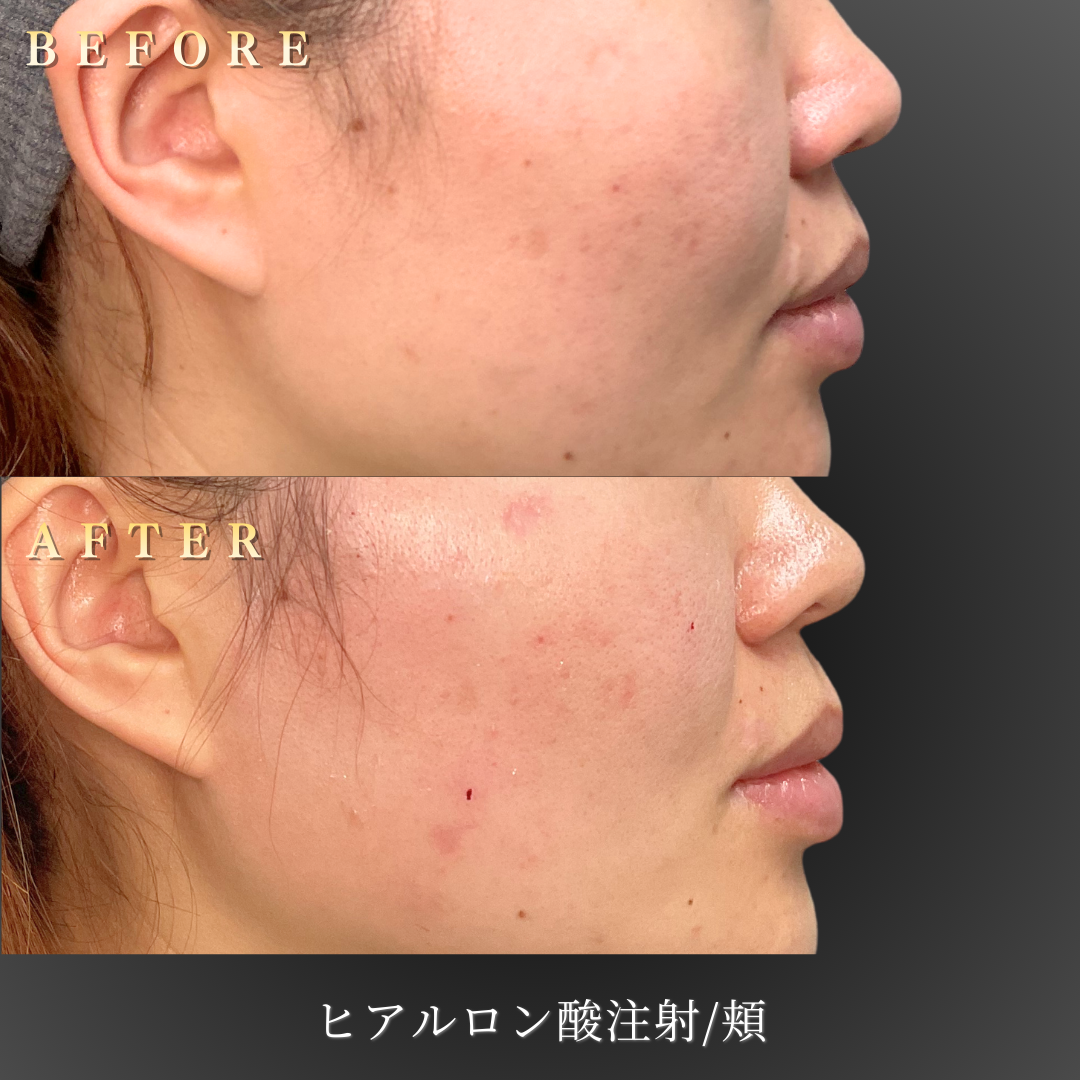 30代女性の中顔面右横ビフォーアフター、疲れ顔改善症例