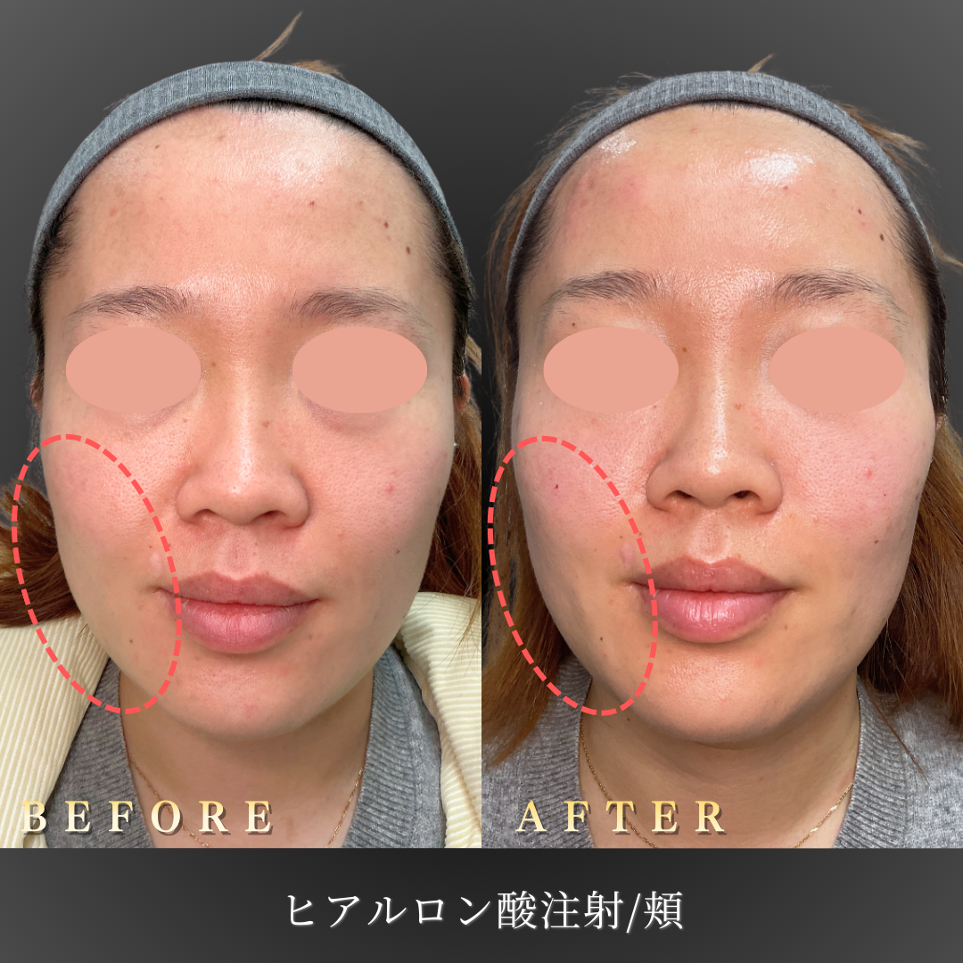 【30代女性】疲れ顔を改善する中顔面ヒアルロン酸症例｜大阪 心斎橋BiBiクリニックの症例写真