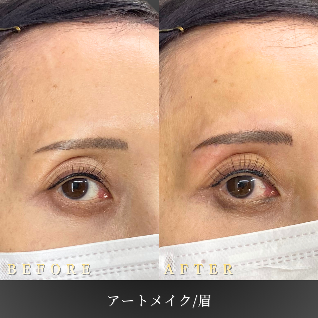 40代女性の眉アートメイク施術前後の右45度からの比較写真