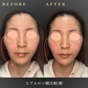 40代 頬ヒアルロン酸 症例写真〔正面Before_After〕｜大阪 心斎橋BiBiクリニック