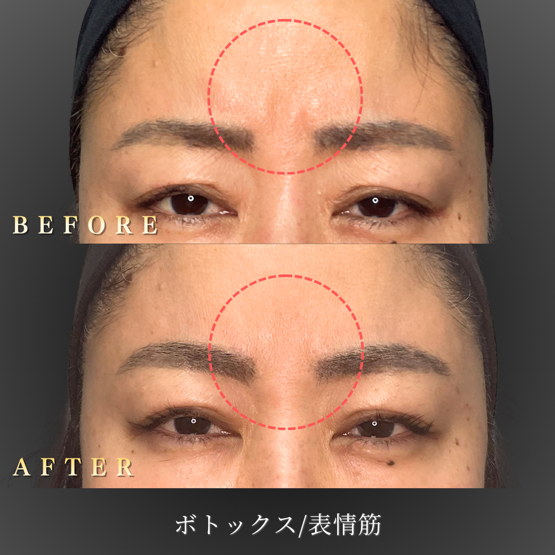 【40代女性】ビエノックスで眉間の表情ジワを改善するシワ改善ボトックス症例｜大阪 心斎橋BiBiクリニックの症例写真