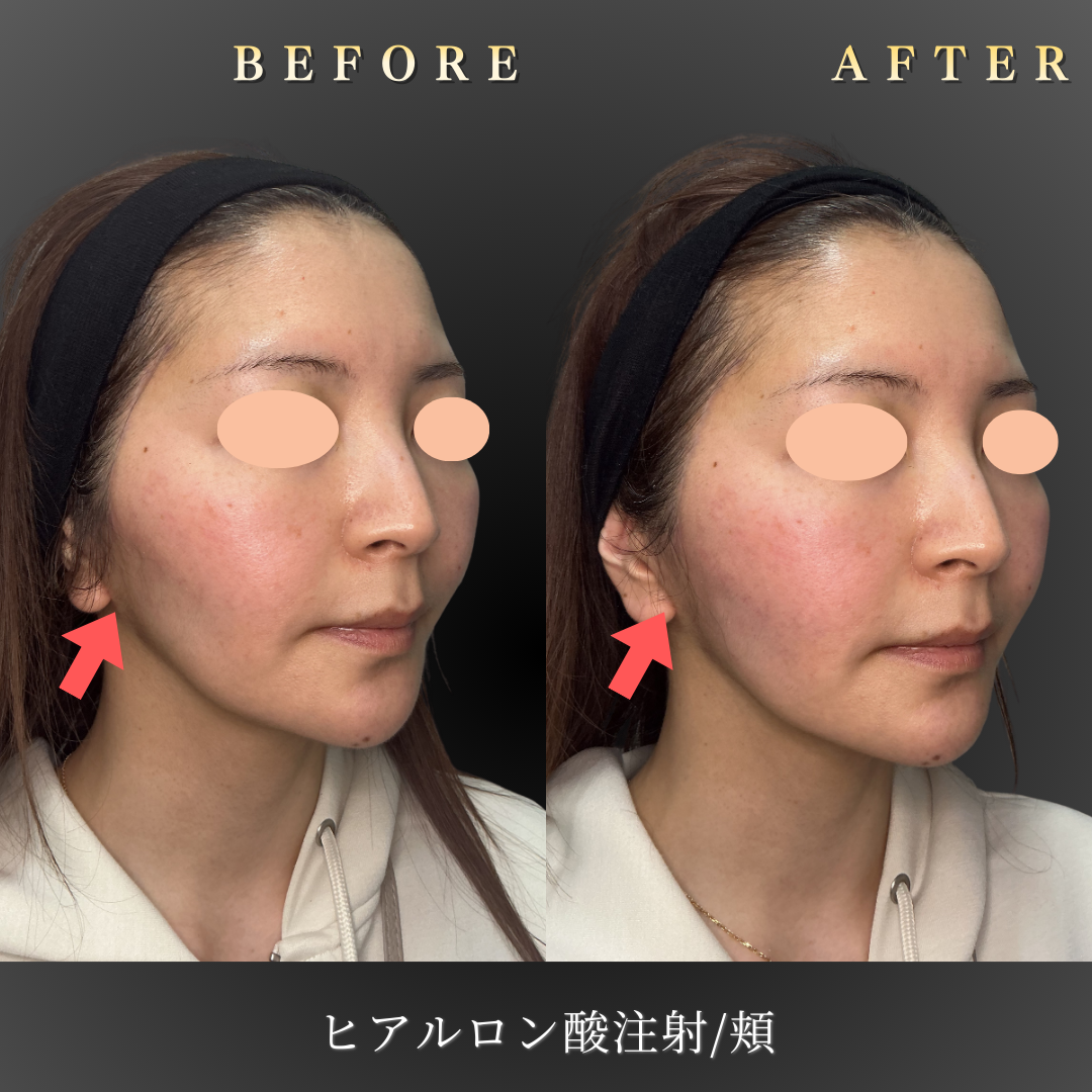 30代女性の中顔面ヒアルロン酸施術 右45度Before/After