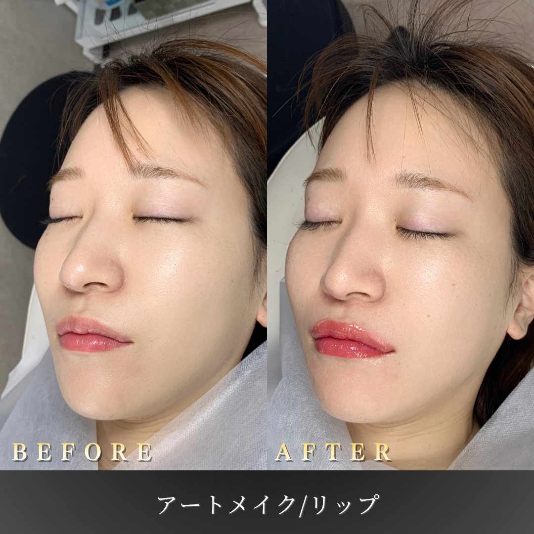 【20代女性】血色を補うリップアートメイク症例｜大阪 心斎橋BiBiクリニックの症例写真