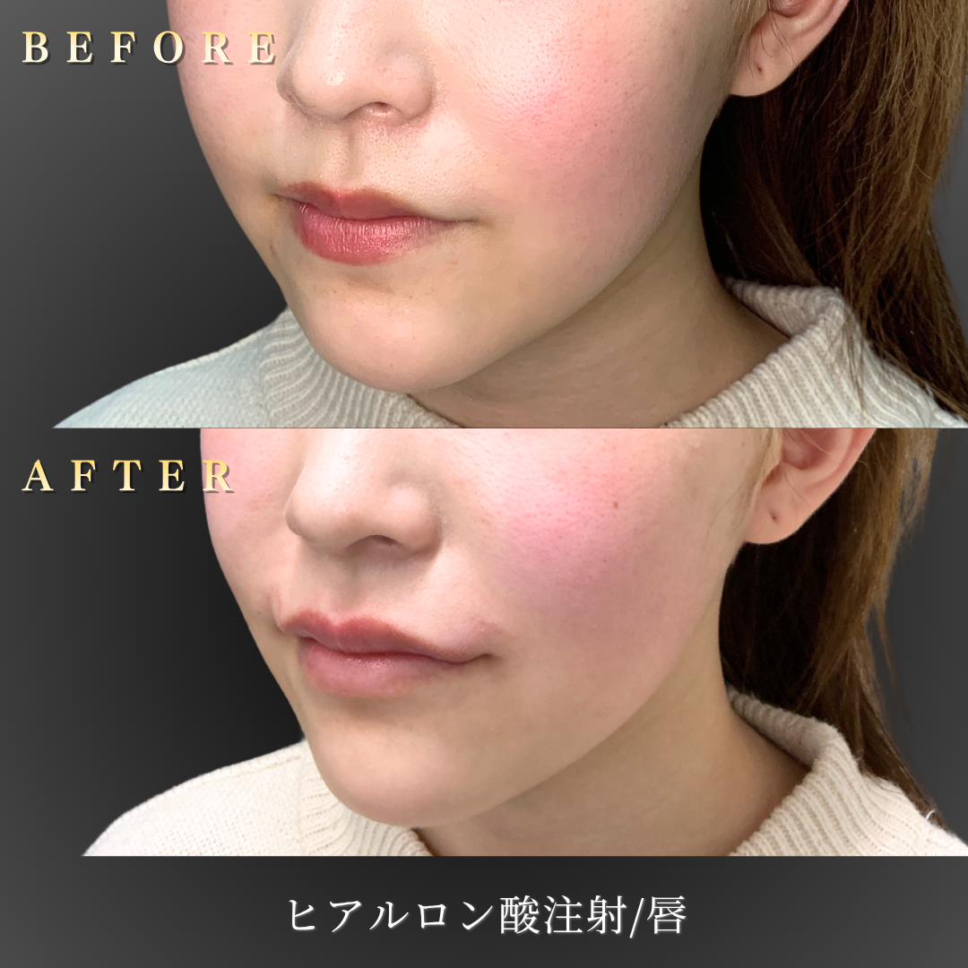 【20代女性】M字リップを作るヒアルロン酸症例｜大阪 心斎橋BiBiクリニックの症例写真