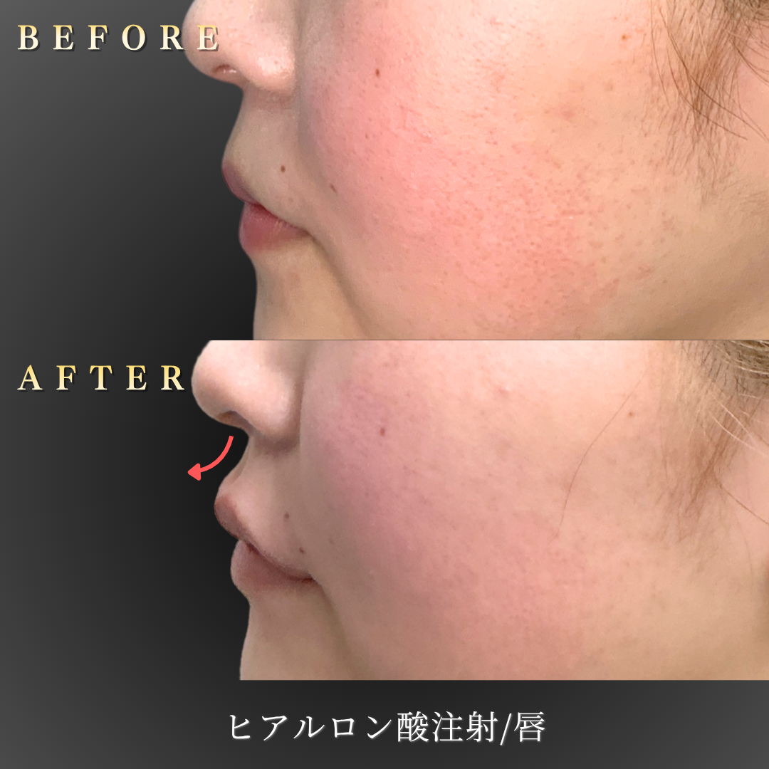 20代女性のM字リップ症例 左横からの写真