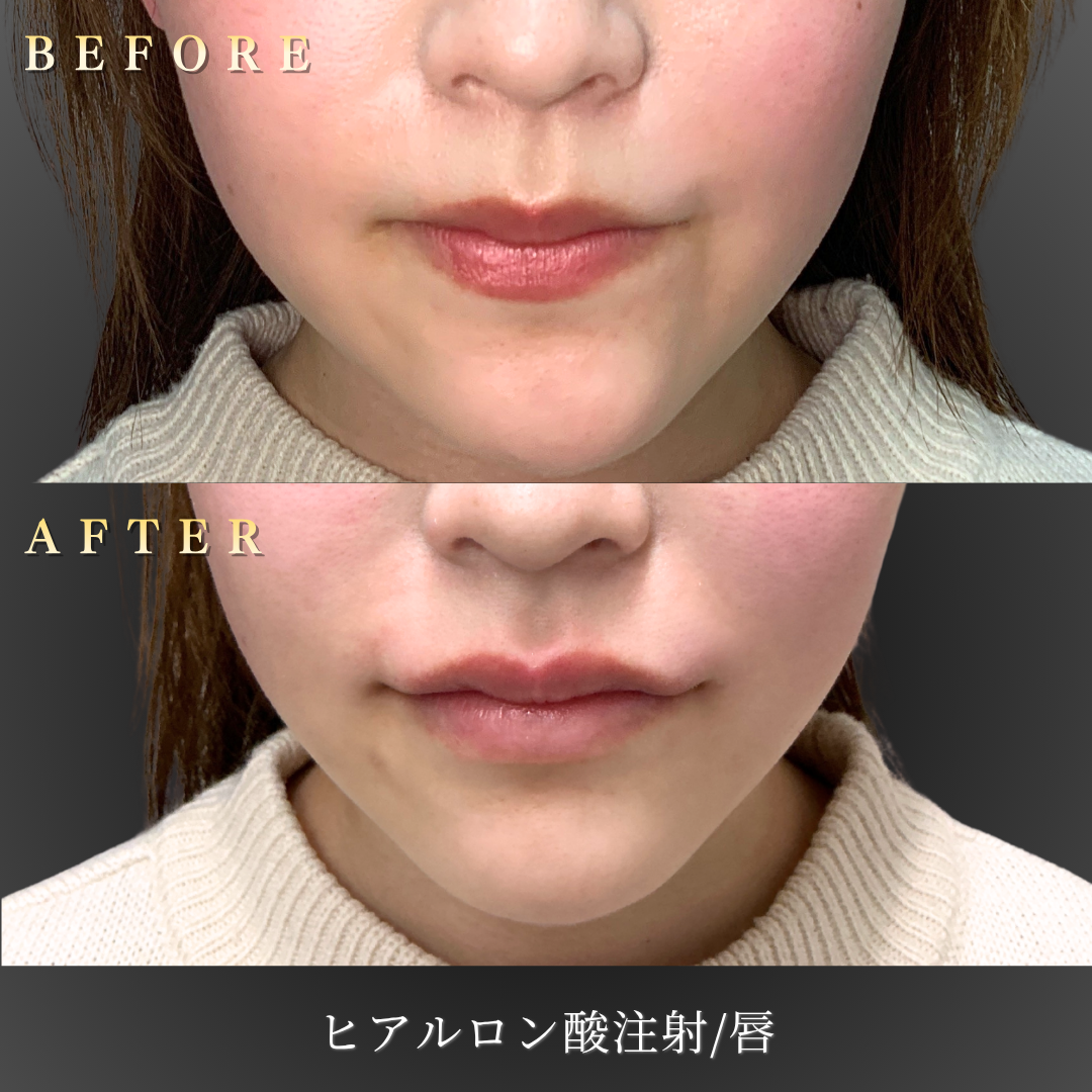 20代女性のM字リップ作成症例 正面からのビフォーアフター写真