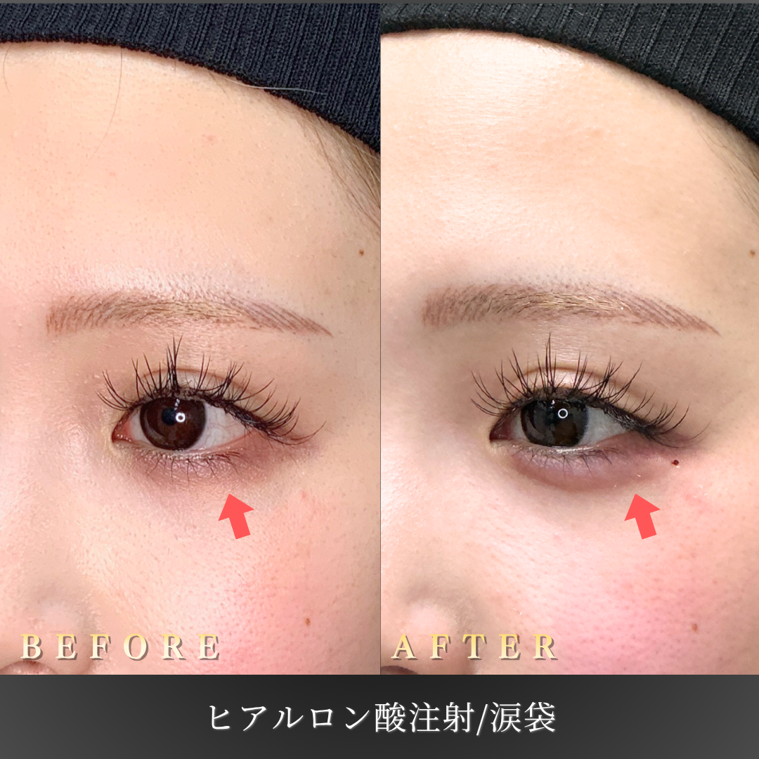 【20代女性】写真写りを意識した涙袋ヒアルロン酸症例｜大阪 心斎橋BiBiクリニックの症例写真