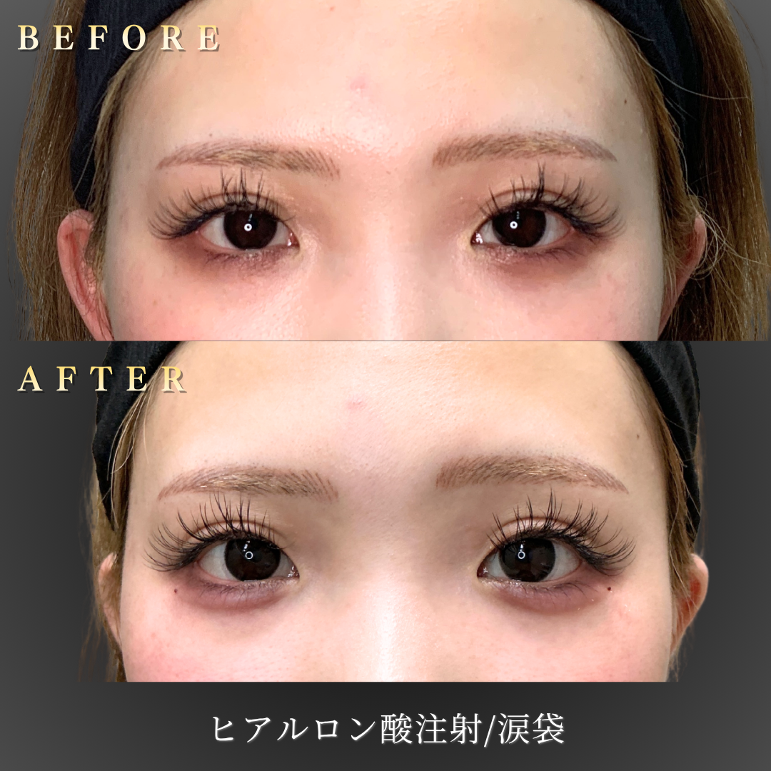 20代女性の涙袋ヒアルロン酸症例 正面のBefore/After写真