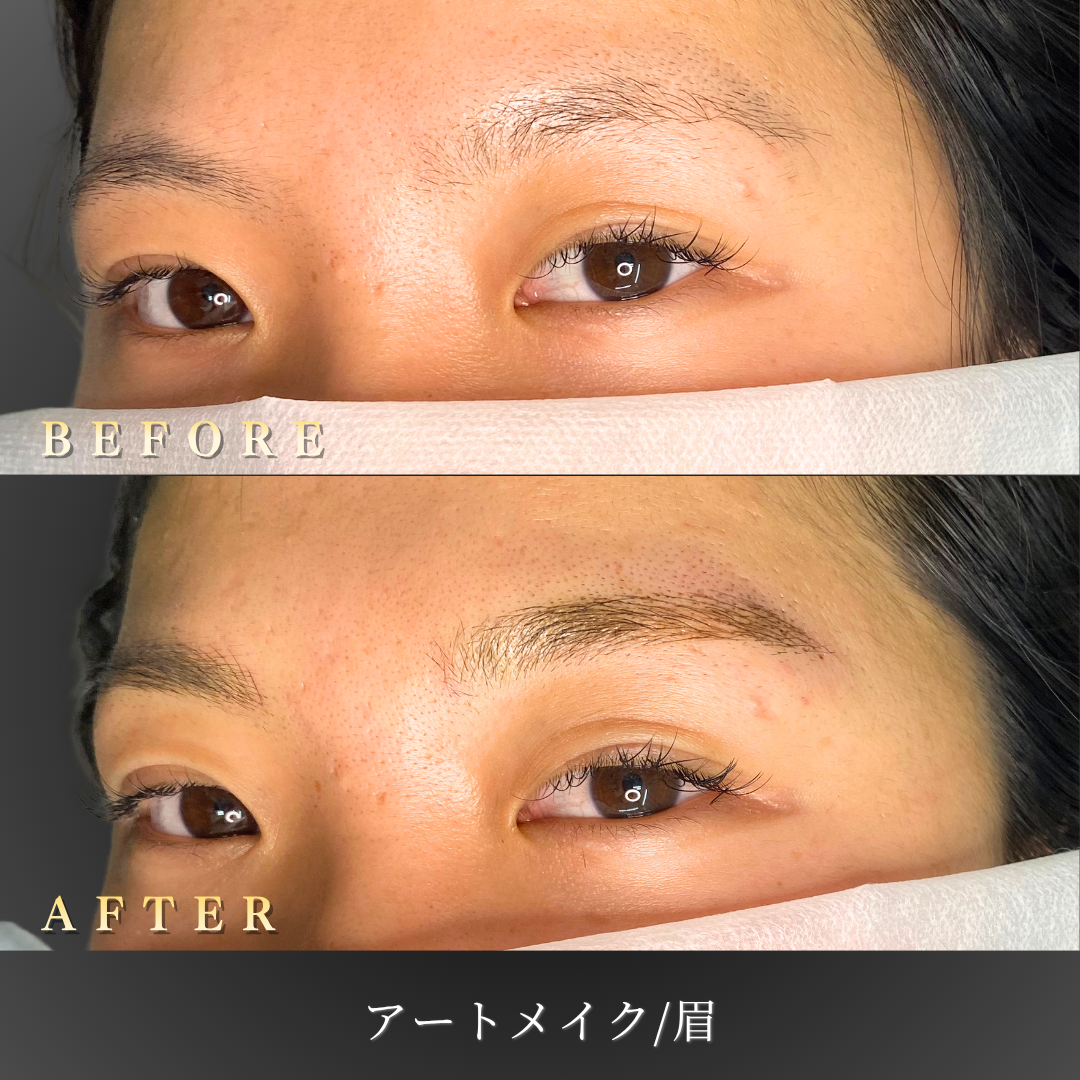 【20代女性】まばら眉を整える眉アートメイク症例｜大阪 心斎橋BiBiクリニックの症例写真